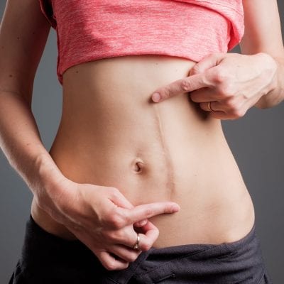 Cirurgia para correção de cicatriz